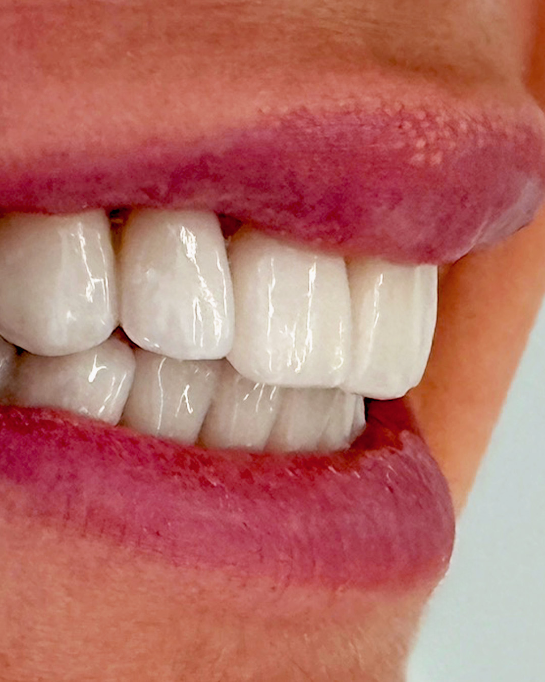 blanqueamiento dental