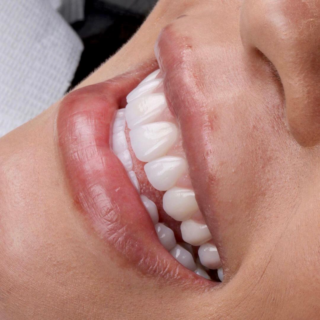 Blanqueamiento dental Philips Zoom