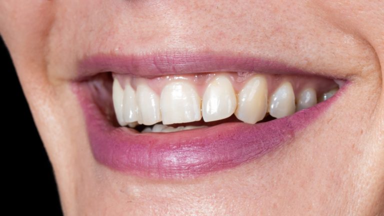 carillas disilicato litio valencia antes