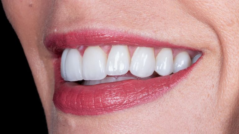 carillas disilicato litio valencia despues