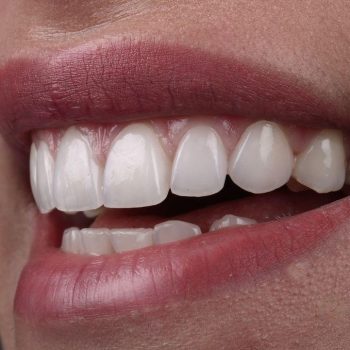 microcarillas tratamiento Mvoca