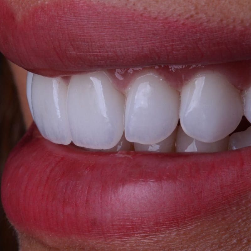 diseño de sonrisa
