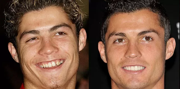 antes y después carillas dentales Cristiano Ronaldo