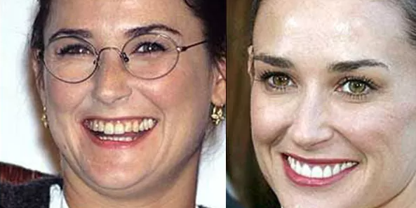 antes y después carillas dentales Demi Moore