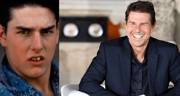 antes y después carillas dentales Tom Cruise