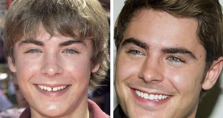 antes y después carillas dentales Zac Efron