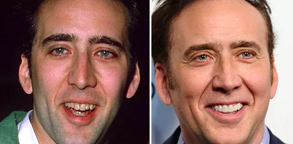 antes y después carillas dentales Nicolas Cage