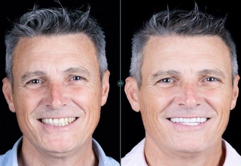 Antes y después de las carillas dentales