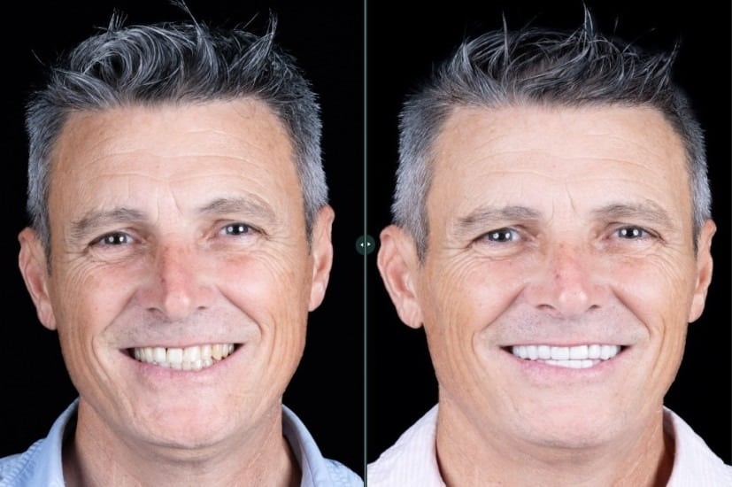 Antes y después de las carillas dentales