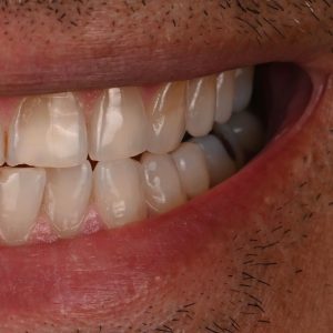 microcarillas dentales antes