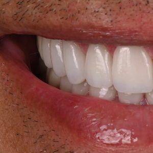 microcarillas dentales después resultado