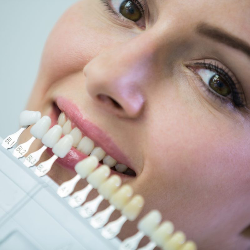 Qué es una carilla dental y cómo se ponen