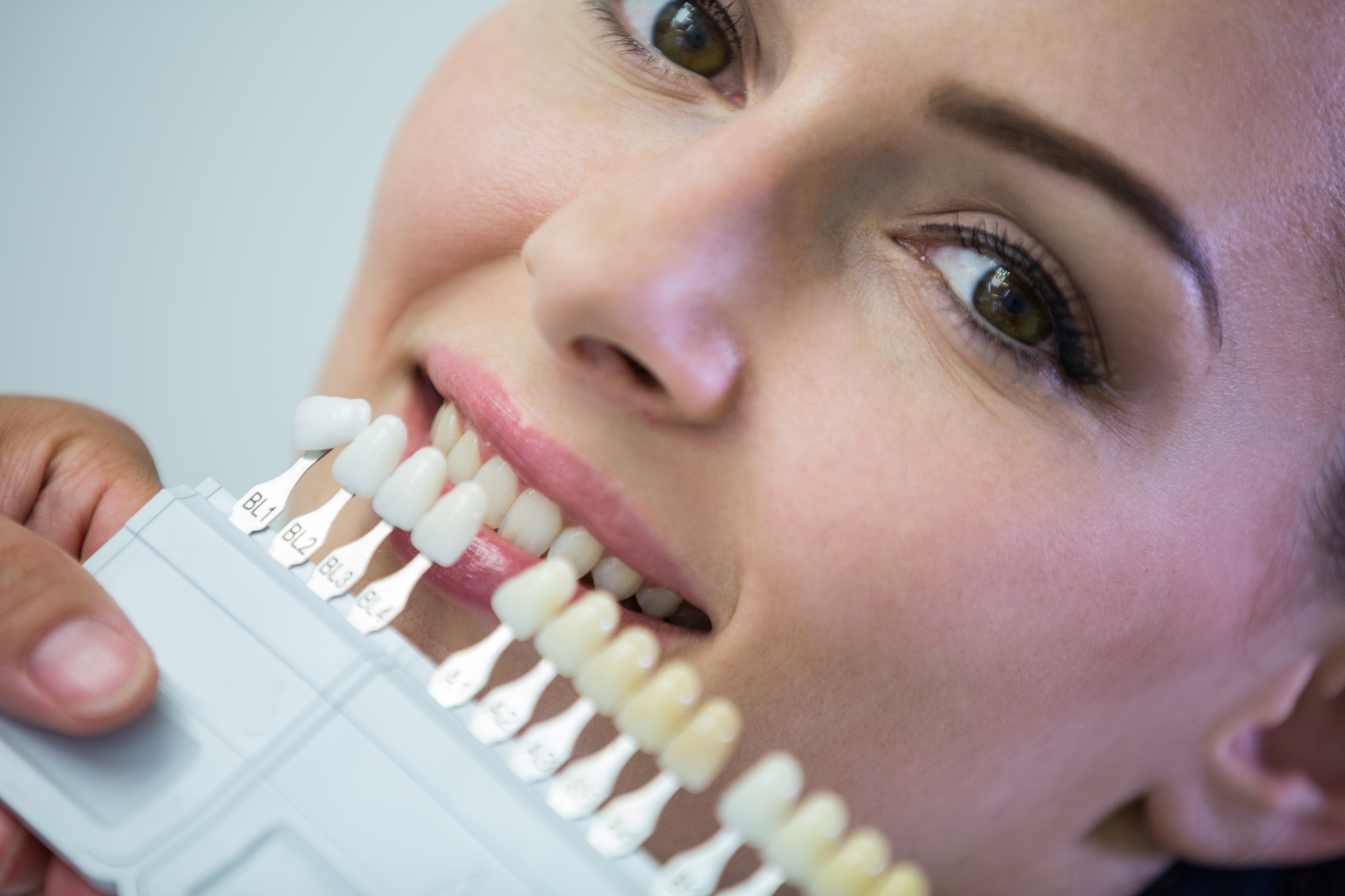 ¿Qué son las carillas dentales y cómo se ponen?: guía completa del tratamiento