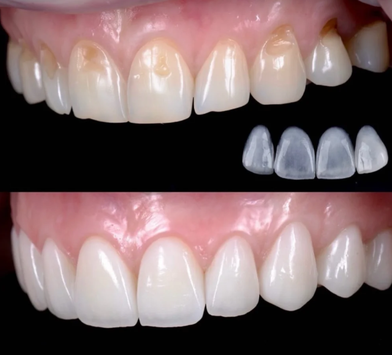 antes y después de las carillas dentales 