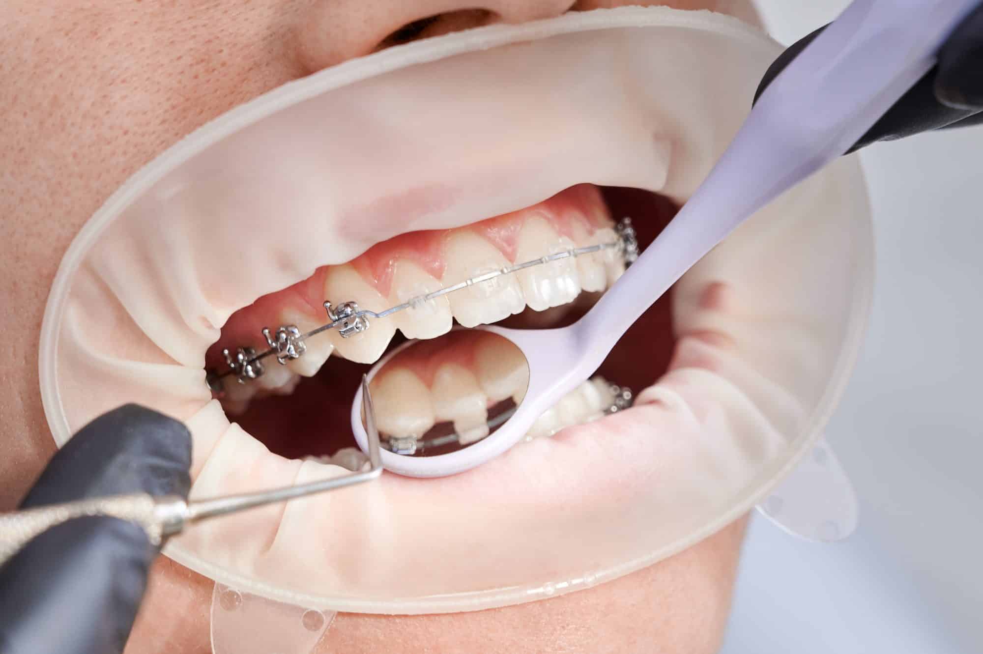 ¿Se puede poner ortodoncia si ya llevas carillas dentales?