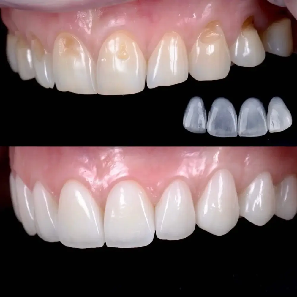 microcarillas dentales