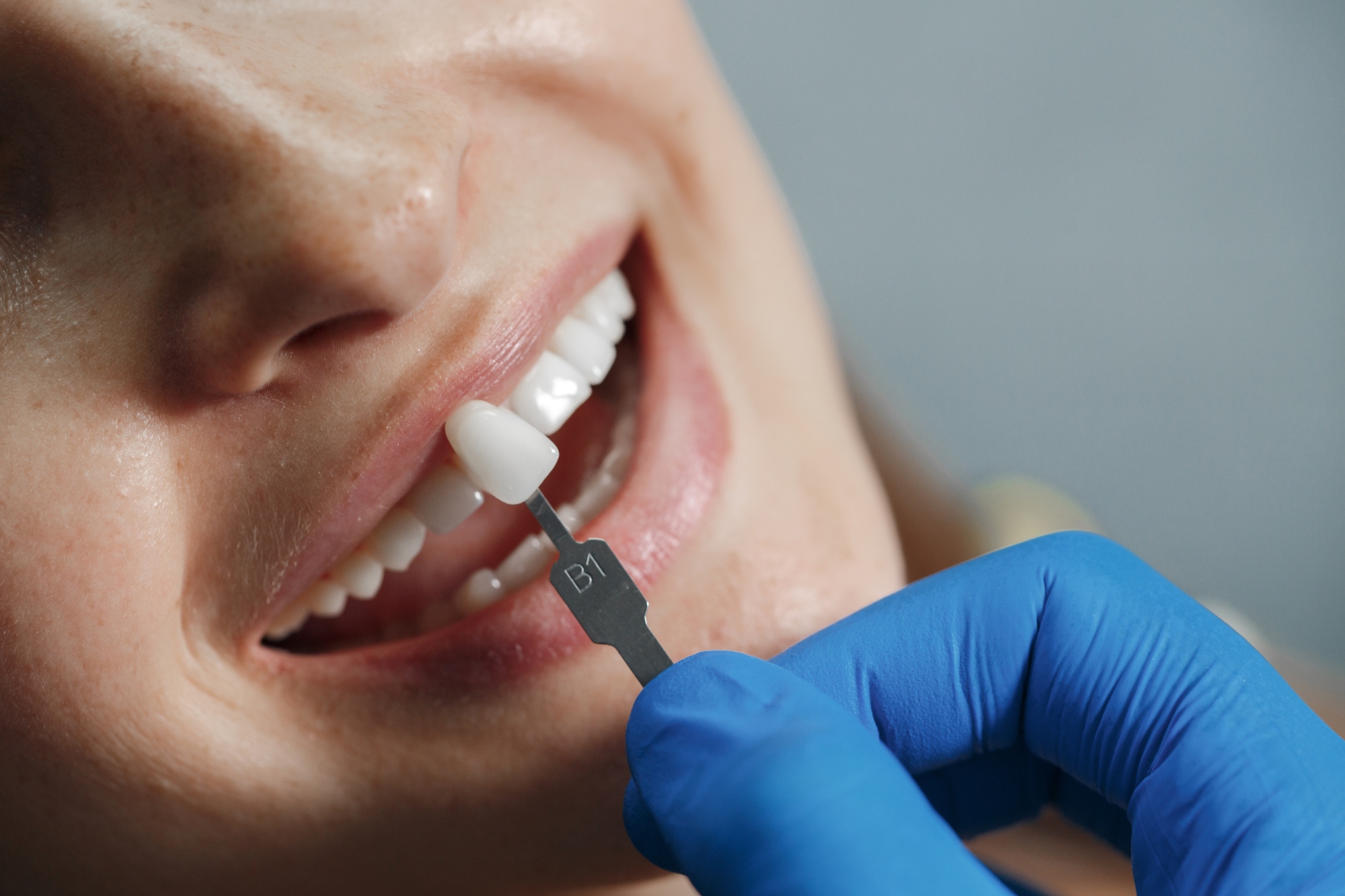 Consigue una sonrisa natural y resistente con nuestras carillas de porcelana
